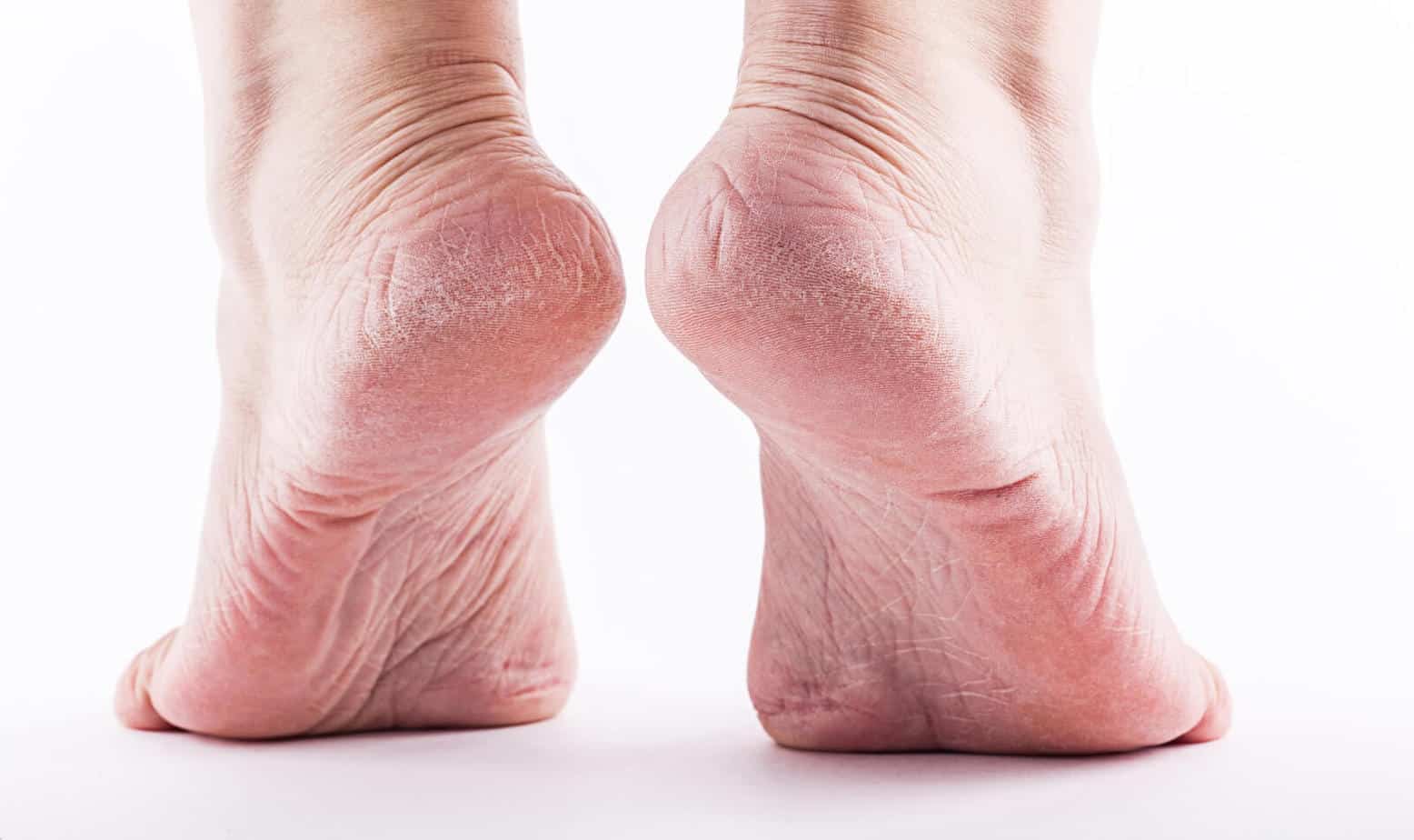 dehydrated skin on the heels of female feet