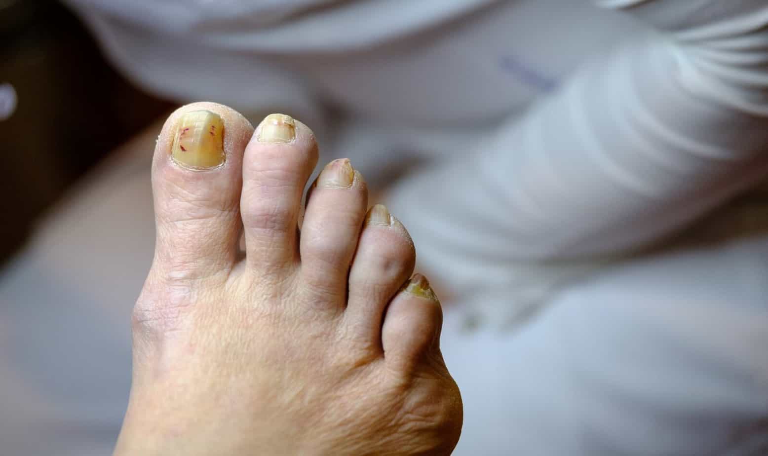 Sick unhealthy nails on the foot of a man