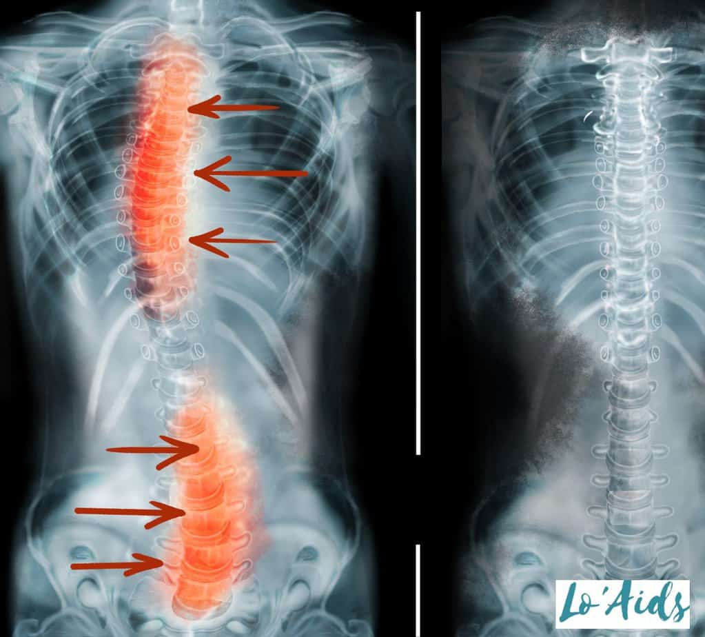 x-ray of Spinal Column with issues